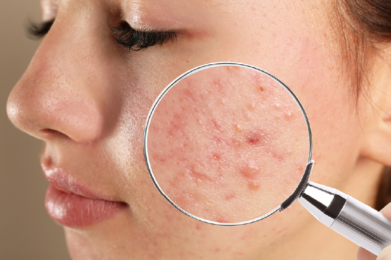 Vitamina D e Acne